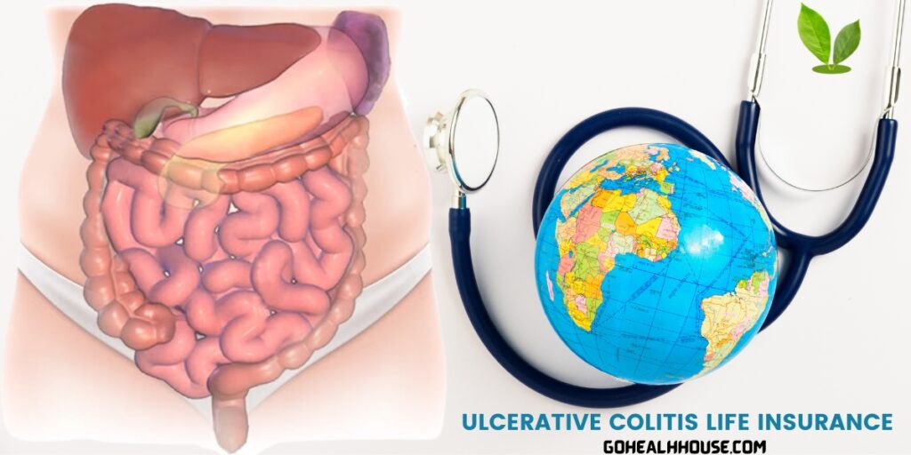 Ulcerative Colitis Life Insurance